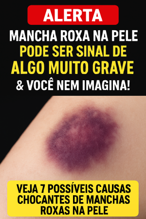 ALERTA: Mancha roxa na pele pode ser SINAL DE ALGO MUITO GRAVE e você nem imagina!